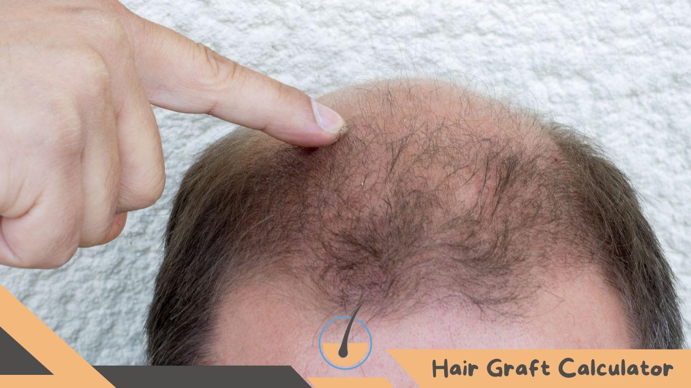 Hair Transplant Scars Prevention and Treatment Options